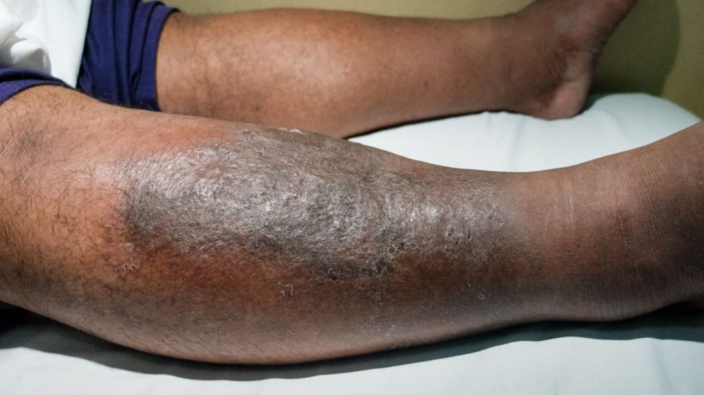 Cellulitis