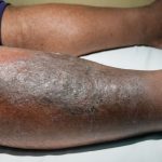 Cellulitis