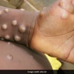 pox